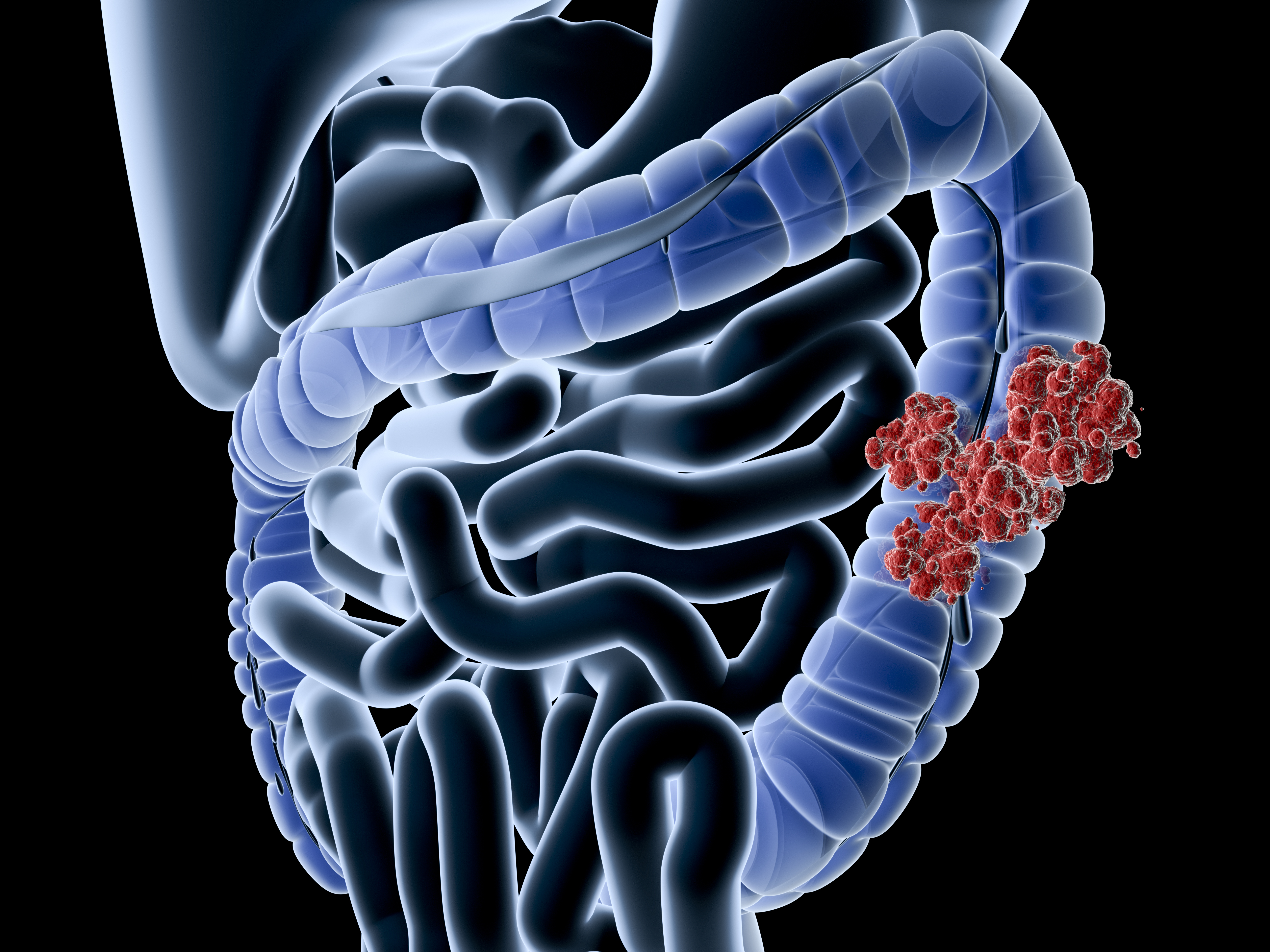 Intestinal E Coli Infections Sepsis Alliance